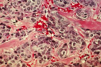 Cancerous breast tissue, with normal connective tissue (pink) and cancer cells (blue). 